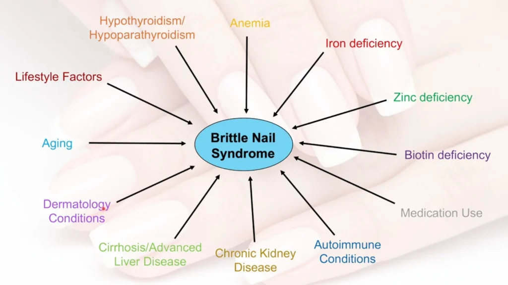 Brittle nail infographic diagram that show Causes, Signs & Symptoms.