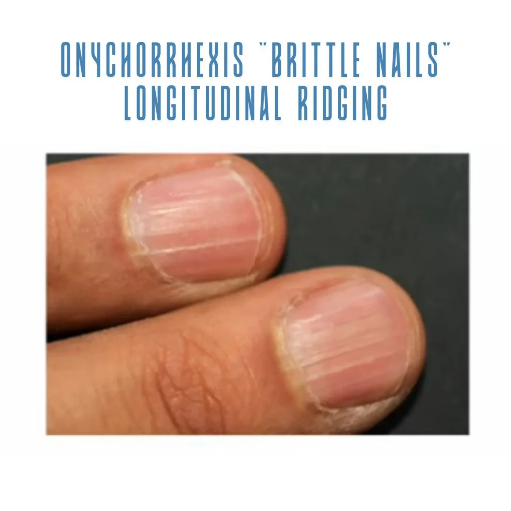 A Onychorrhexis Brittle nails Longitudinal ridging